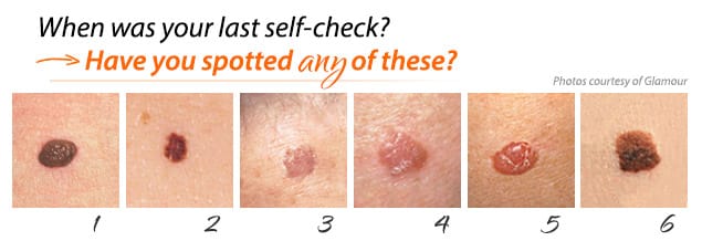 Skin Cancer Treatments La Jolla Chula Vista East Lake Ca Dermatology