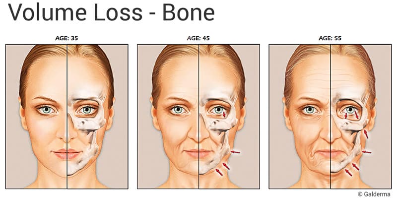 Facial Bone Loss 25