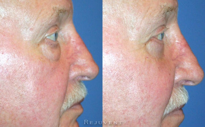 Lower Blepharoplasty Patient 1