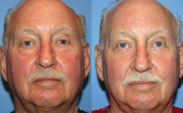 Lower Blepharoplasty Patient 2
