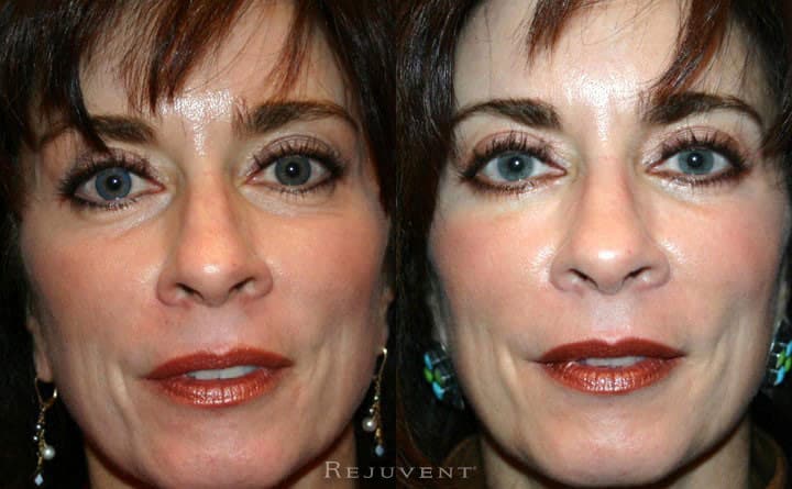 Lower Blepharoplasty Patient 3