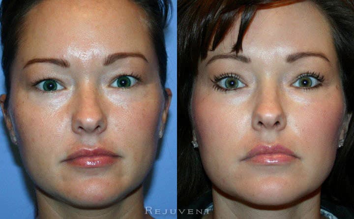 Upper Blepharoplasty Patient 1