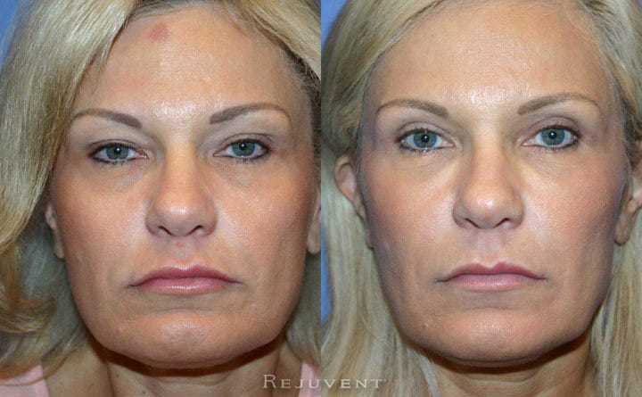 Upper Blepharoplasty Patient 2