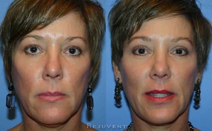 Upper Blepharoplasty Patient 3