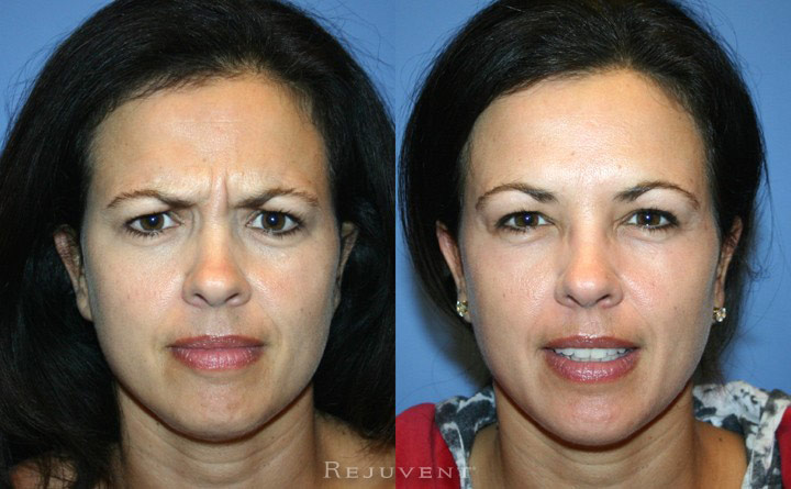 Botox on the eleven lines