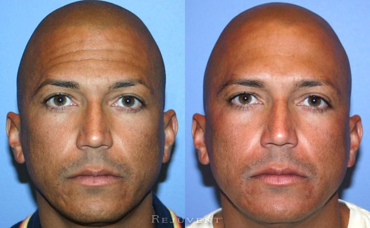 Botox on forehead before and after