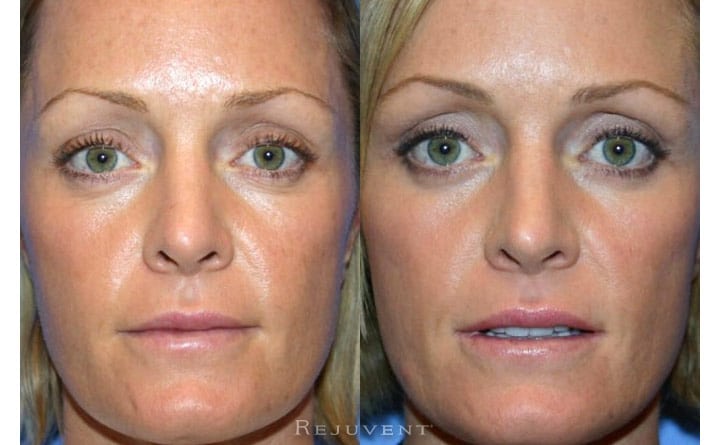 Lower Blepharoplasty Patient 4