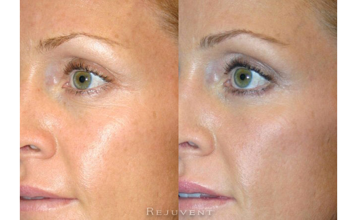 Lower Blepharoplasty Patient 5