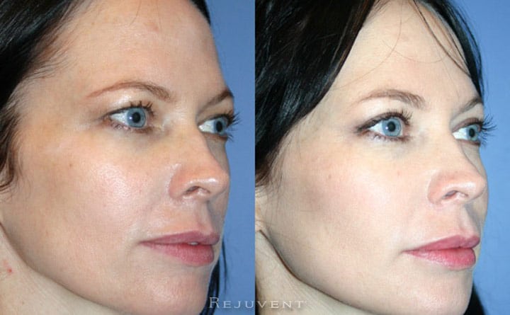 Upper Blepharoplasty Patient 4