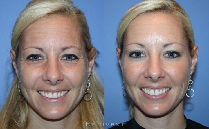 Beautiful botox results achieved at Rejuvent. See the Rejuvent Difference for yourself!