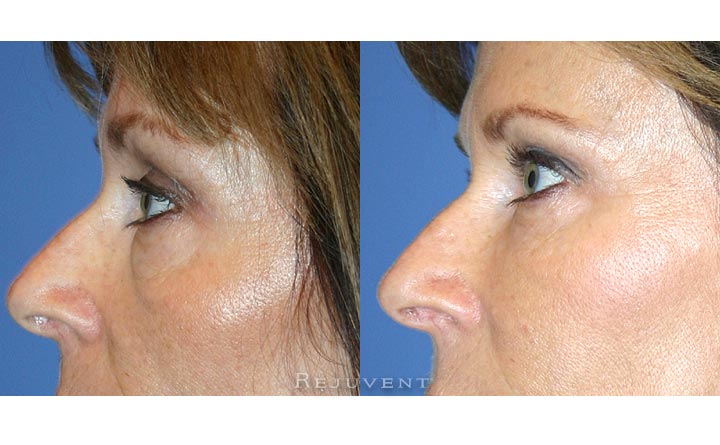 Filler Eye Female 4