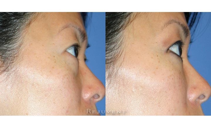 Filler Eye Female 5