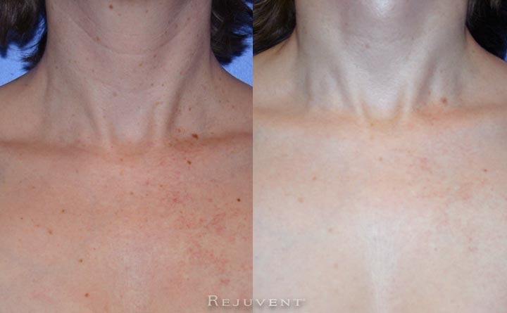 FotoFacial Chest 1