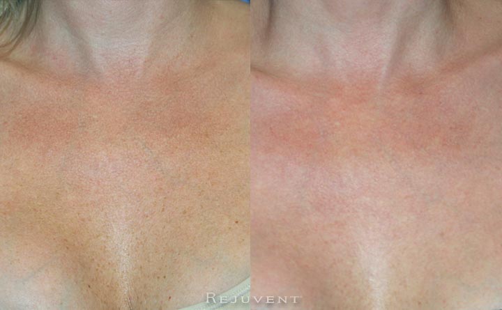 FotoFacial Chest 2