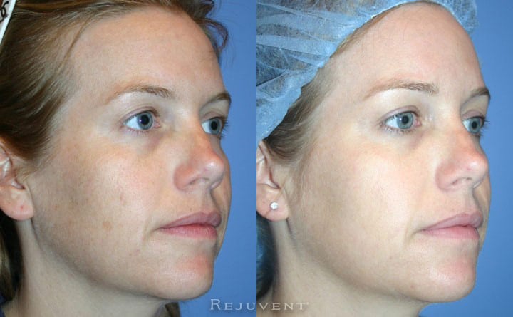 FotoFacial