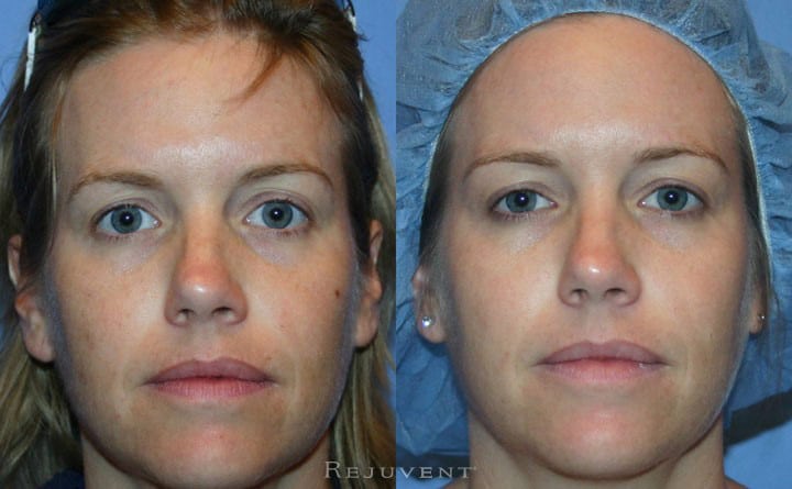 FotoFacial