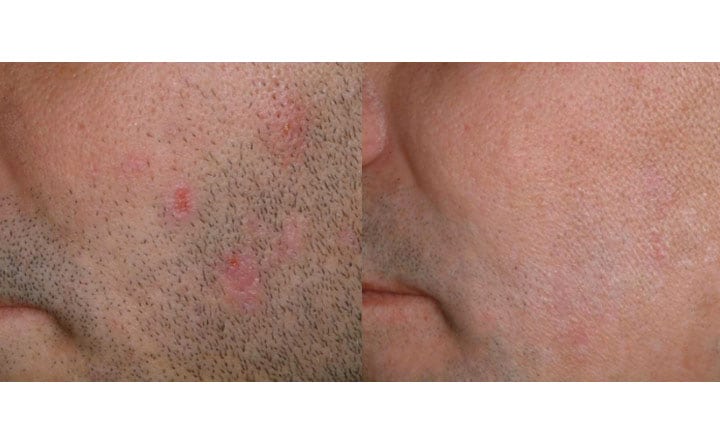 Laser Hair Removal before and after