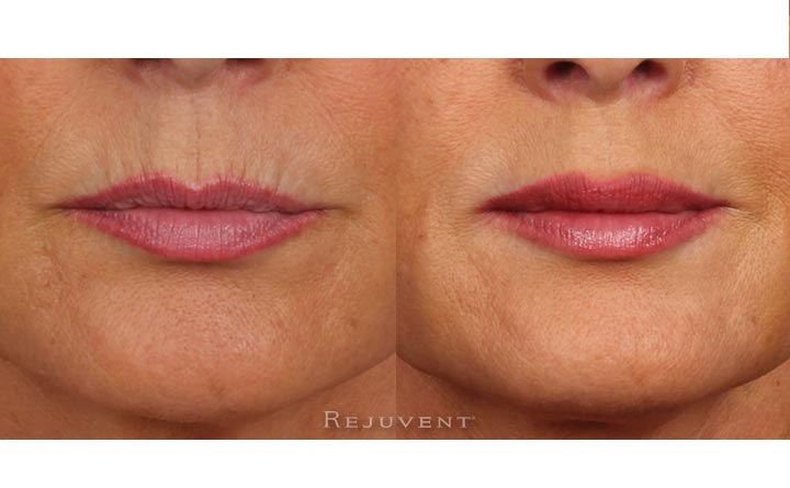 Fuller Lips and smoother lip lines