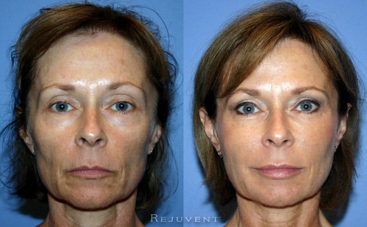 Liquid Facelift the Non-surgical face lift
