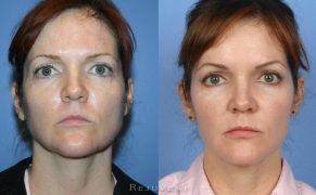 Liquid Facelift Natural Filler Results