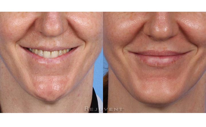 Chin No Surgery Female 5