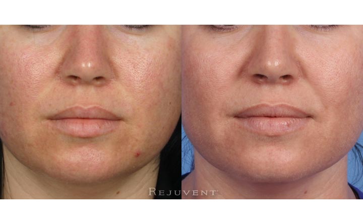 Dermaplaning Chemical Peel Rejuvapen Fotofacial Microdermabrasion Patient 2