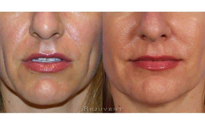 medical facials, chemical peels, firming skin
