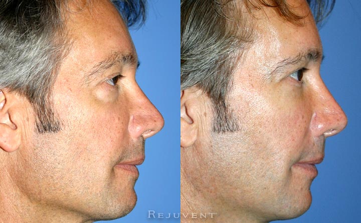 Under Eye filler male patient
