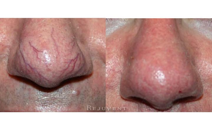 Veinwave Treatment Nose