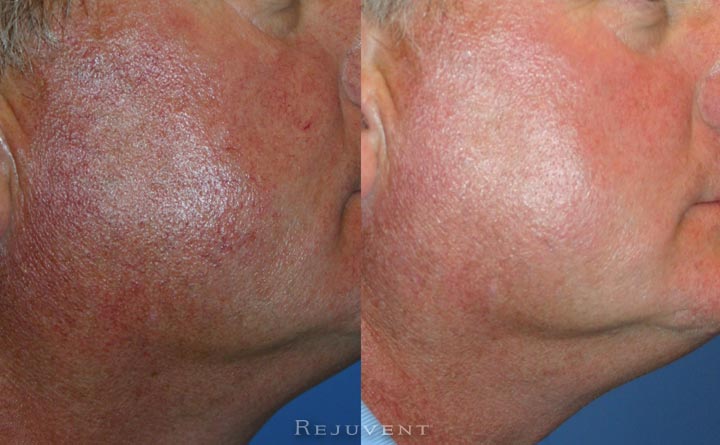 Veinwave Treatment