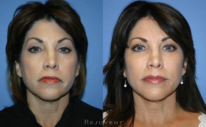 Liquid Facelift Patient 10
