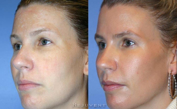 Liquid Facelift Patient 14