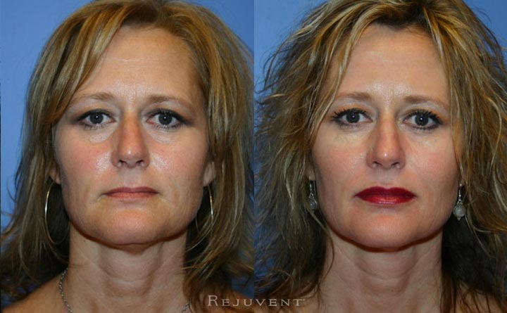 Liquid Facelift Patient 12