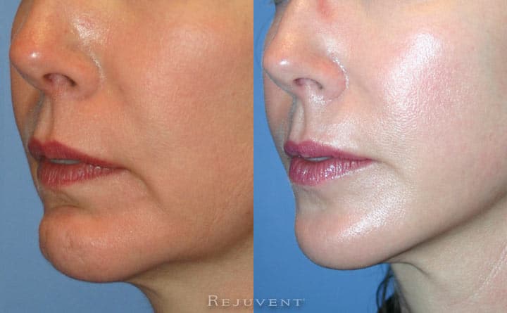 Chin and Facelift