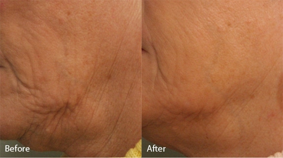 eMatrix Fractional Resurfacing