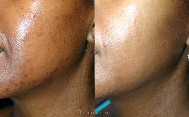 Acne Treatment at Rejuvent