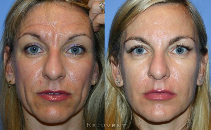 Botox Injections Scottsdale Patient