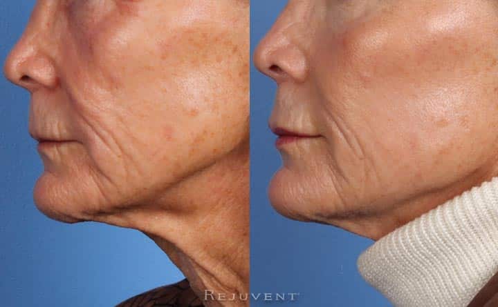 Liquid Facelift Cheek Enhancement