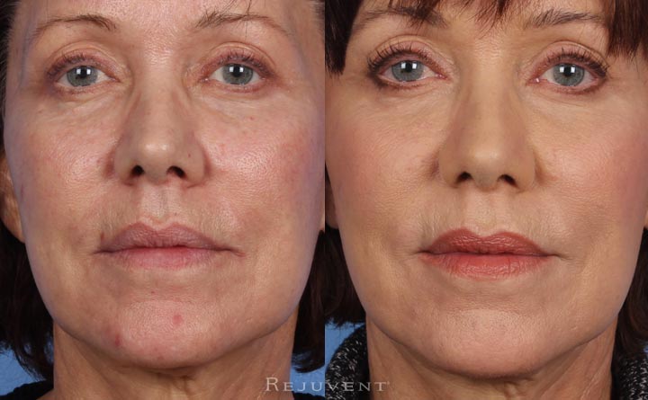 Under Eye Rejuvenation