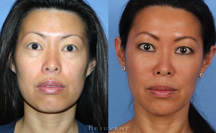 Under eye rejuvenation with derma fillers in Scottsdale