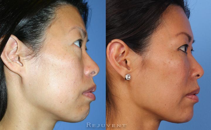 Rejuvenation Under eyes with derma fillers in Scottsdale