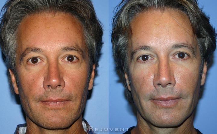 Under Eye rejuvenation with fillers in Scottsdale