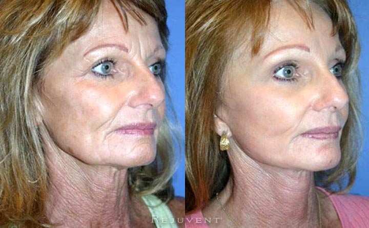 Facelift patient Before and after