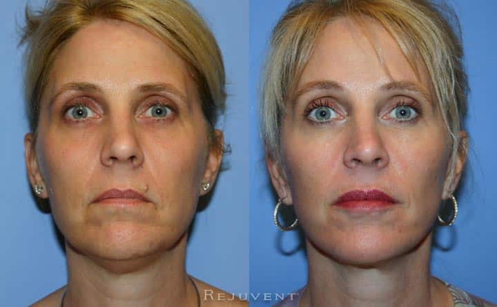 Facelift Before and After
