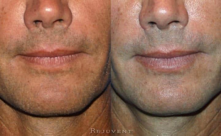 Lip Enhancement