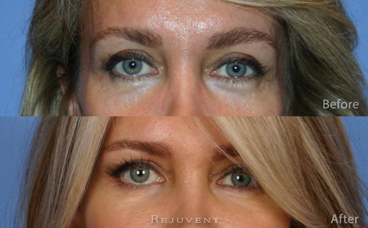 Liquid Facelift andf Under eye rejuvenation, Scottsdale AZ