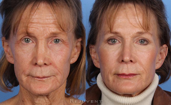 Rejuvent Liquid Facelift