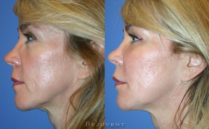Liquid Facelift non surgery facelift