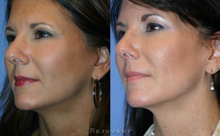 Liquid Facelift Patient at Rejuvent