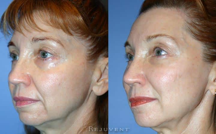 Lower Face rejuvenation with dermal fillers